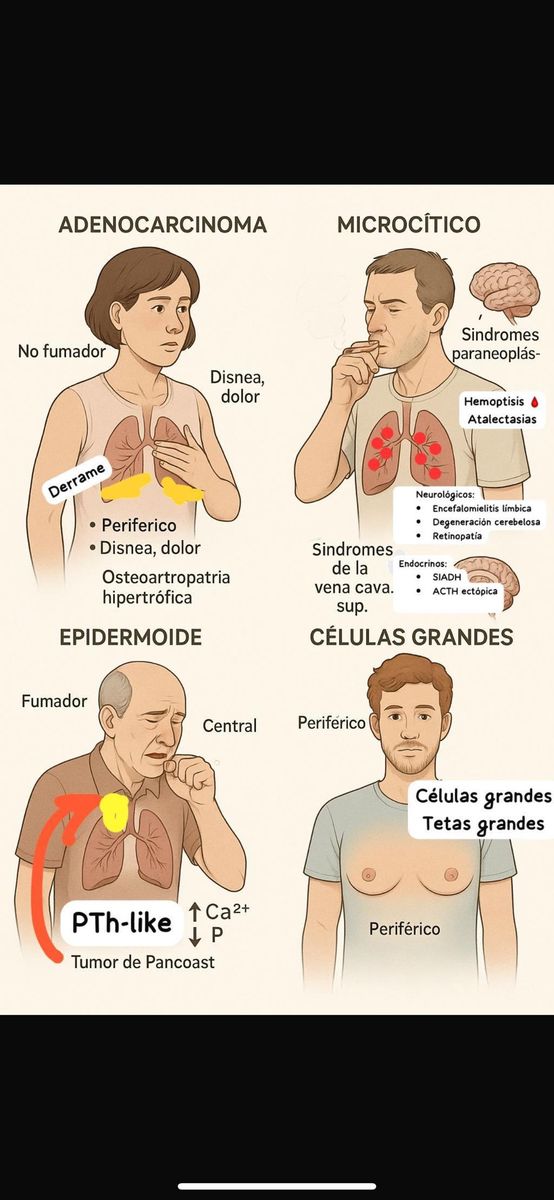 Cáncer de pulmón: los 4 tipos clave