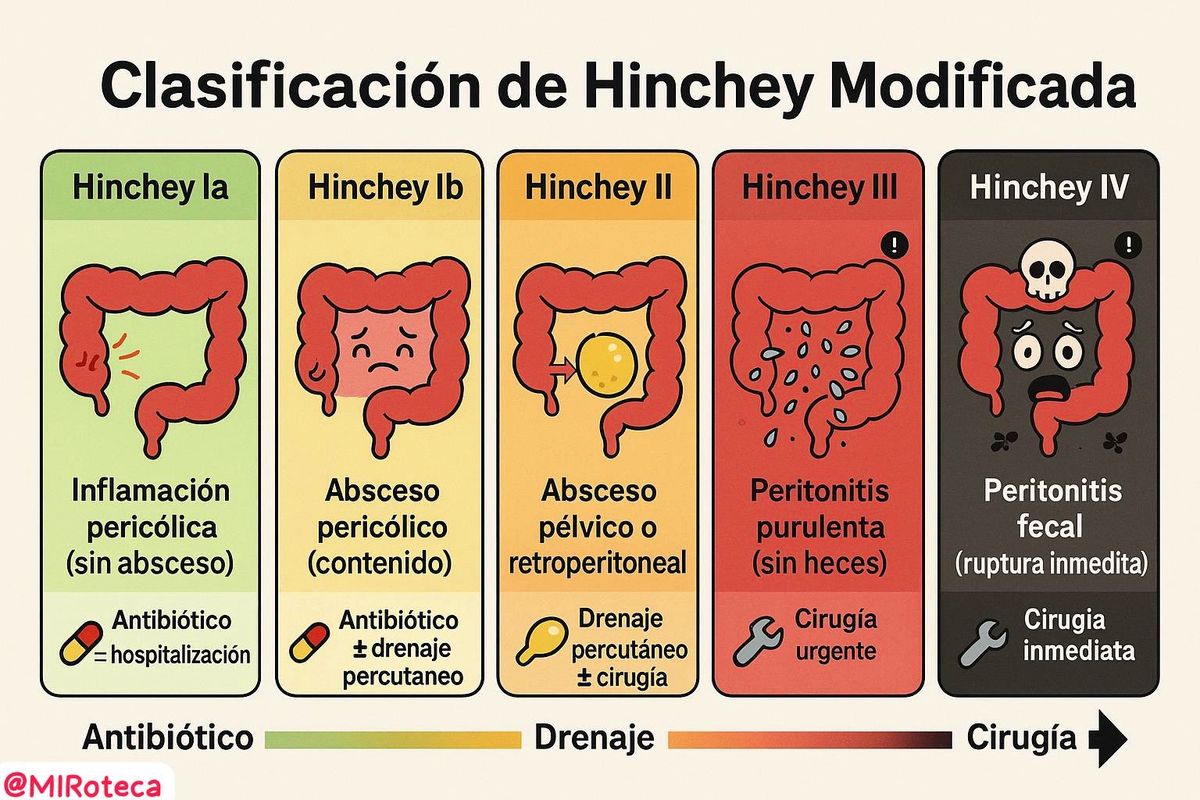 Clasificación de Hinchey (diverticulitis)