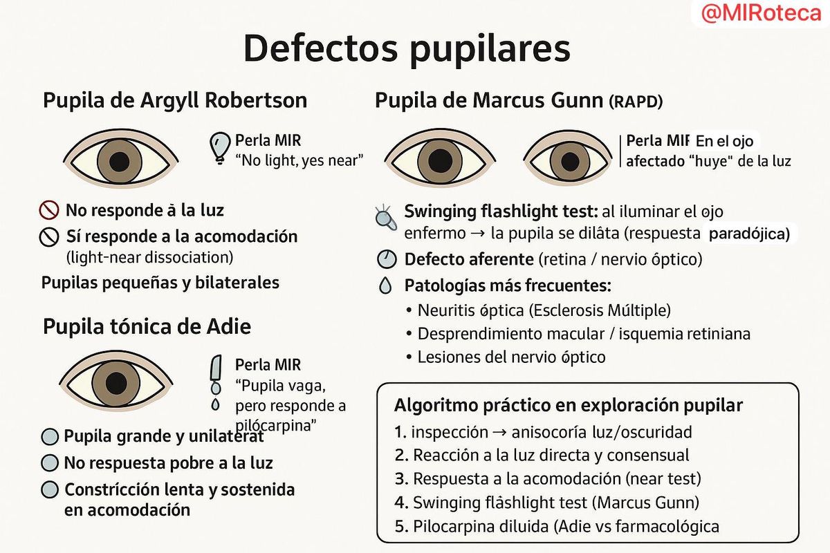 Defectos pupilares: Argyll Robertson, Marcus Gunn y Adie