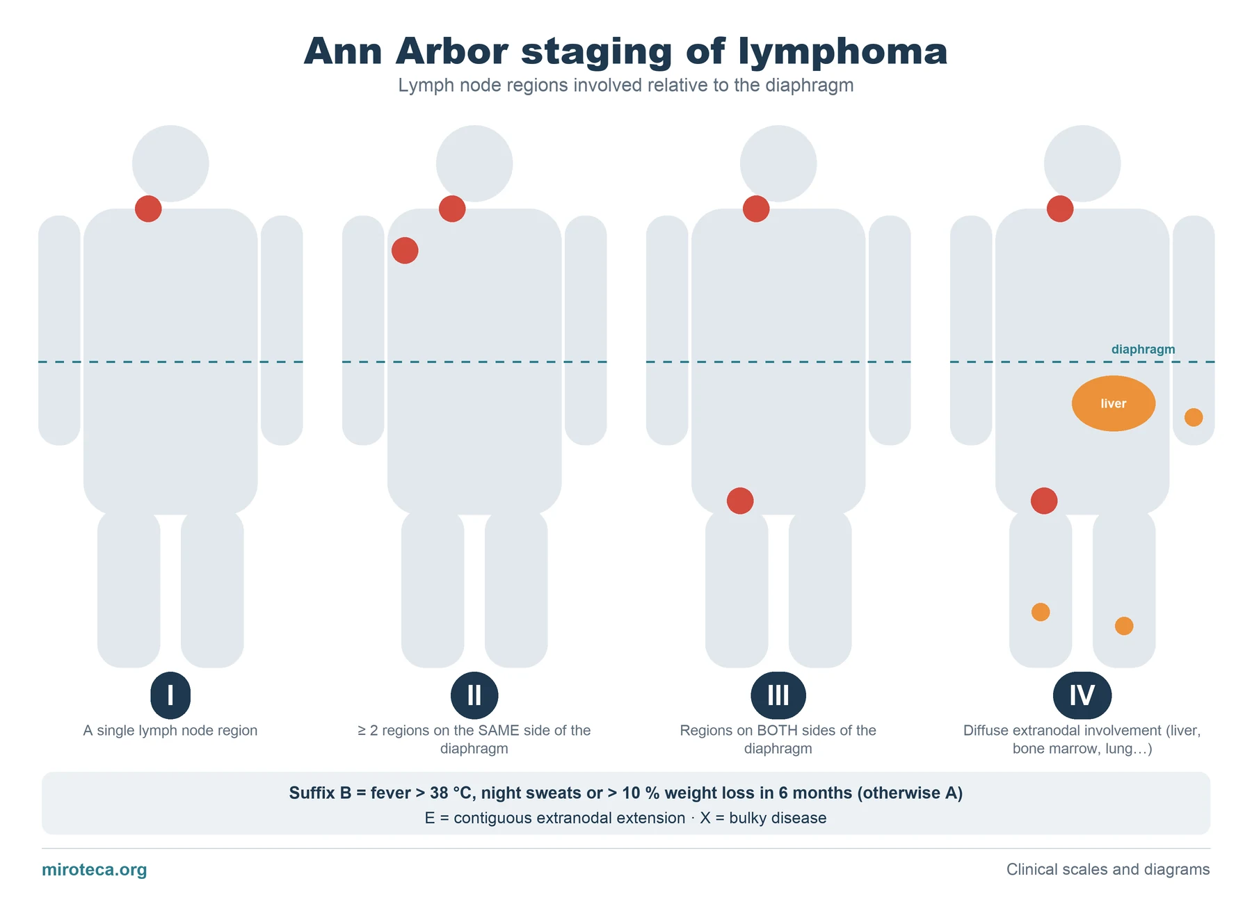 Four body silhouettes with involved lymph nodes in red and the diaphragm marked, showing Ann Arbor stages I, II, III and IV of lymphoma