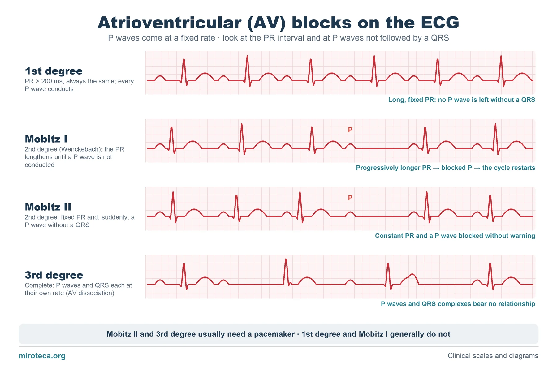 Four ECG strips showing first-degree AV block, Mobitz I or Wenckebach, Mobitz II and complete AV block