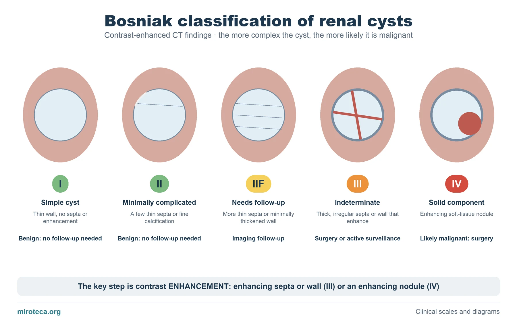 Five kidneys with an increasingly complex cyst illustrating Bosniak categories I, II, IIF, III and IV: septa, thick wall and solid nodule