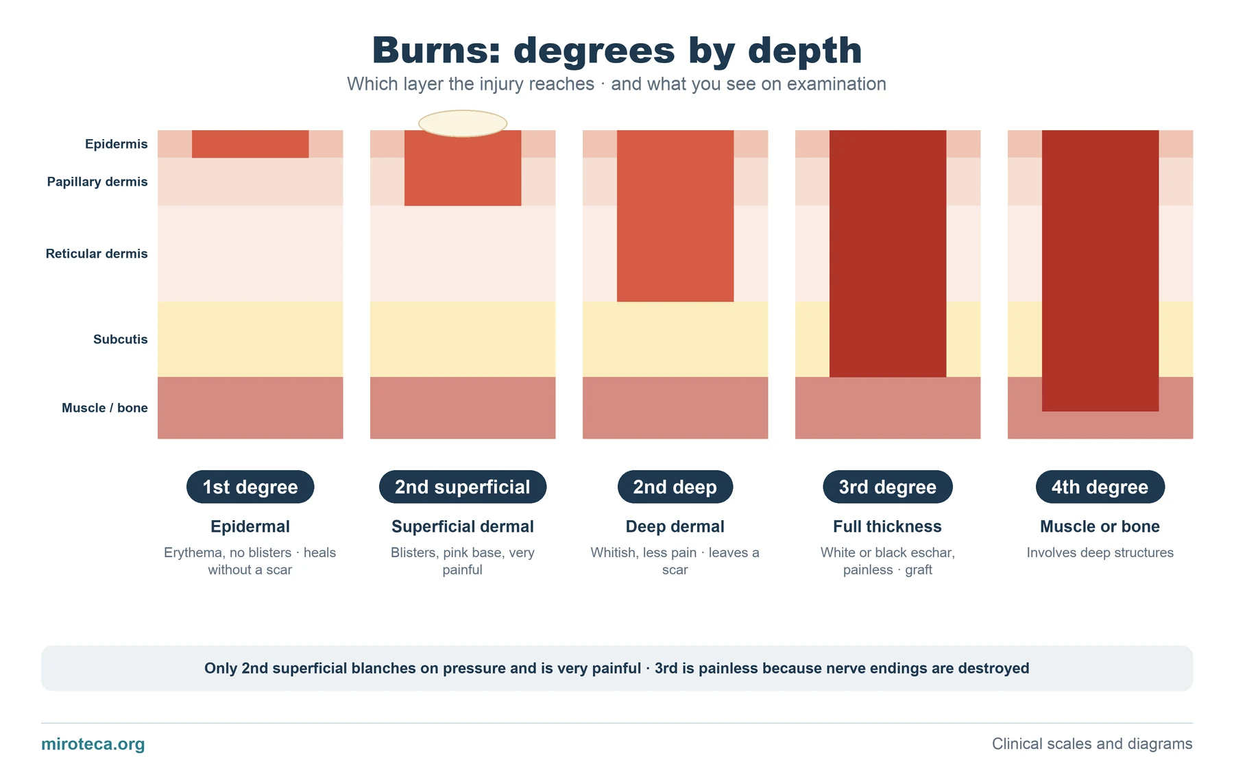 Skin sections with the injury in red reaching deeper each time: first degree, superficial second degree, deep second degree, third and fourth degree burns