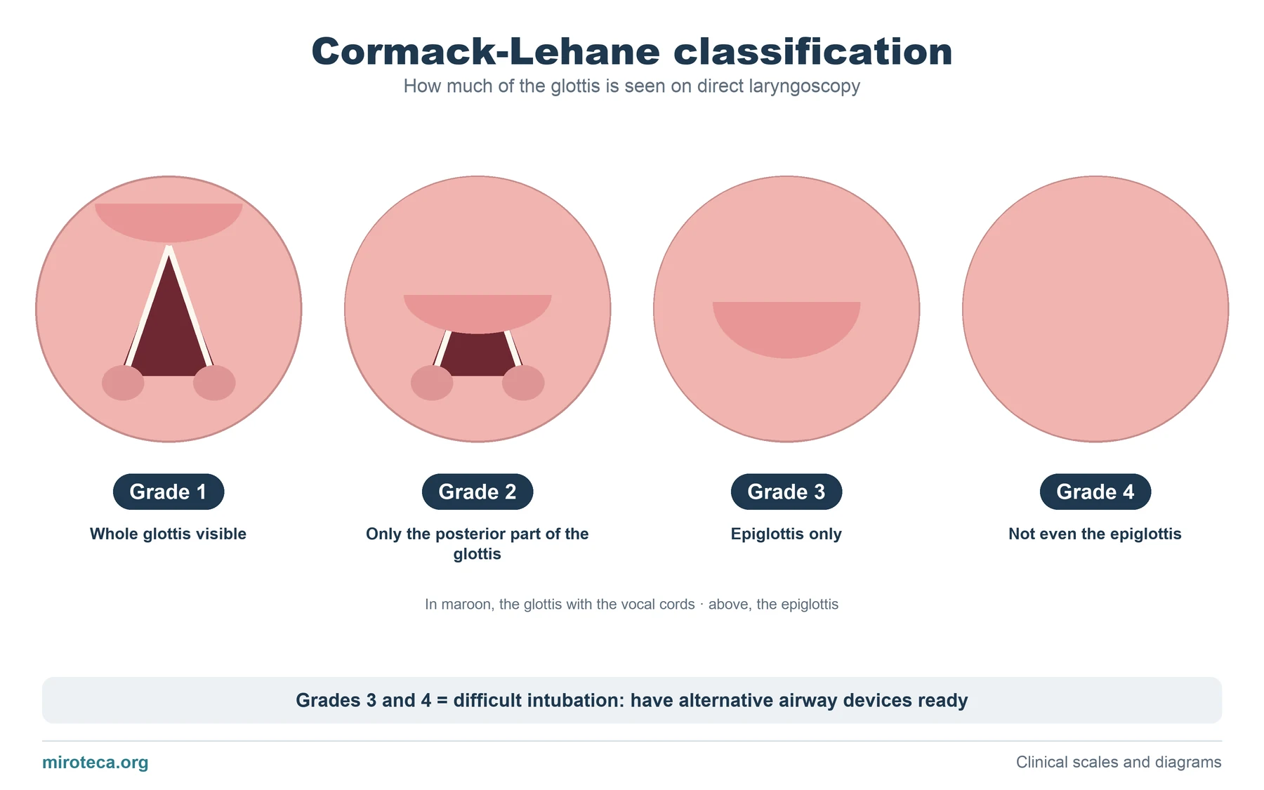 Four laryngoscopic views showing Cormack-Lehane grades 1, 2, 3 and 4, from the whole glottis visible to not even the epiglottis visible