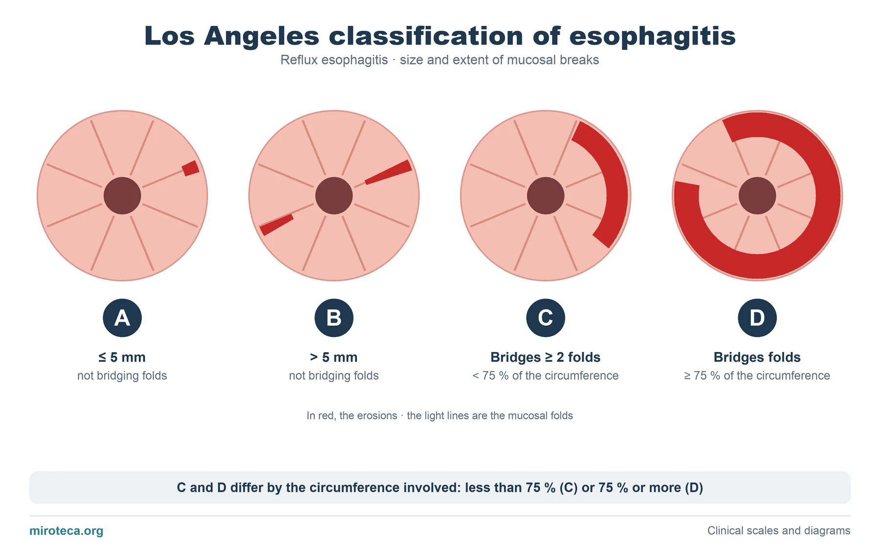 Four endoscopic views of the esophagus with erosions in red illustrating grades A, B, C and D of the Los Angeles classification