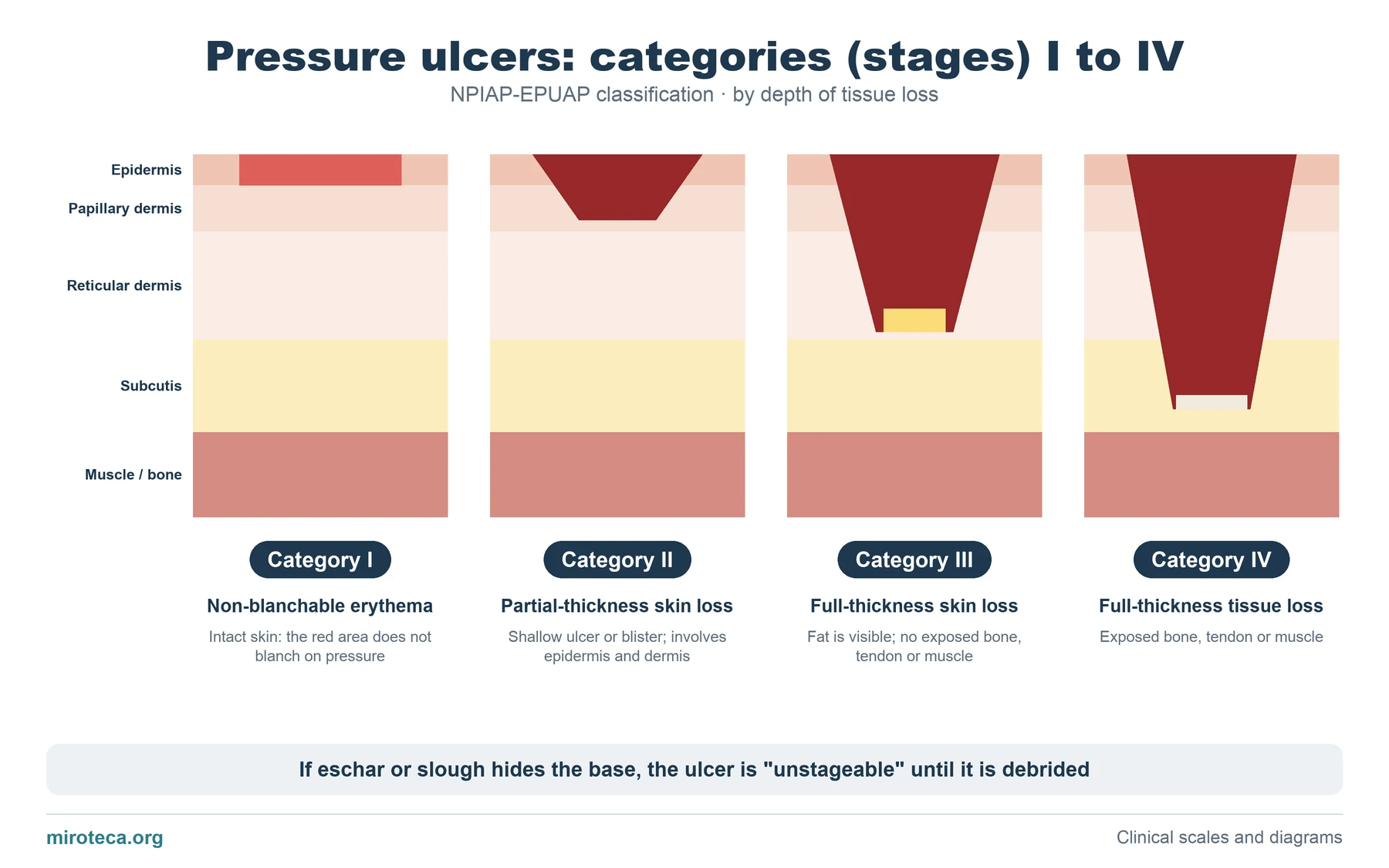 Skin sections with increasingly deep ulcers illustrating pressure ulcer categories I, II, III and IV