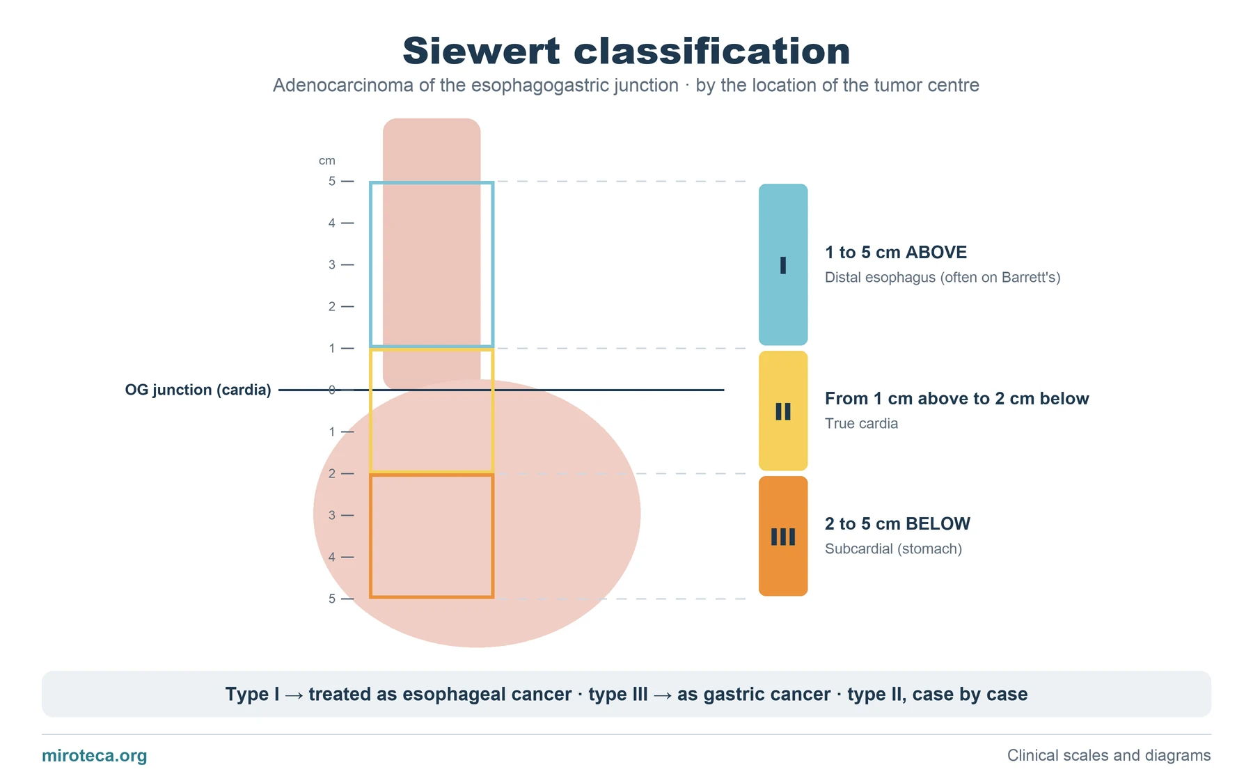 Diagram of the distal esophagus and stomach with a centimeter ruler marking the zones of Siewert types I, II and III relative to the esophagogastric junction