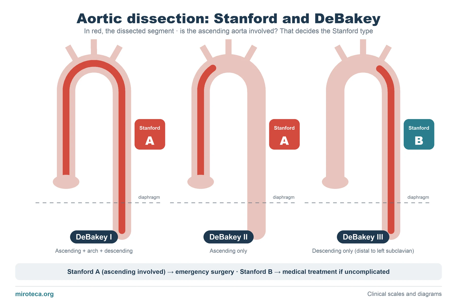 Three drawings of the aorta with the dissected segment in red showing DeBakey types I, II and III and their equivalence with Stanford A and B