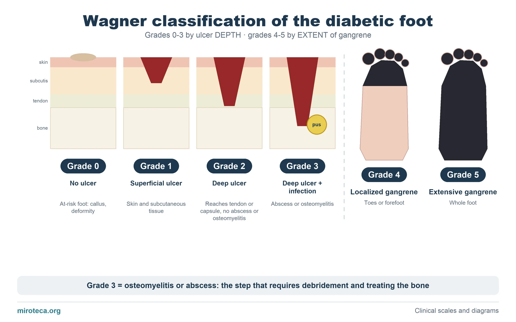 Diagram of the Wagner classification: skin sections with increasingly deep ulcers for grades 0 to 3 and two feet with localized and extensive gangrene for grades 4 and 5