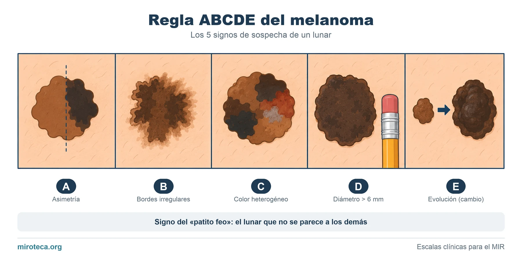 Regla ABCDE del melanoma: asimetría, bordes irregulares, color heterogéneo, diámetro mayor de 6 mm y evolución, ilustrados sobre un lunar