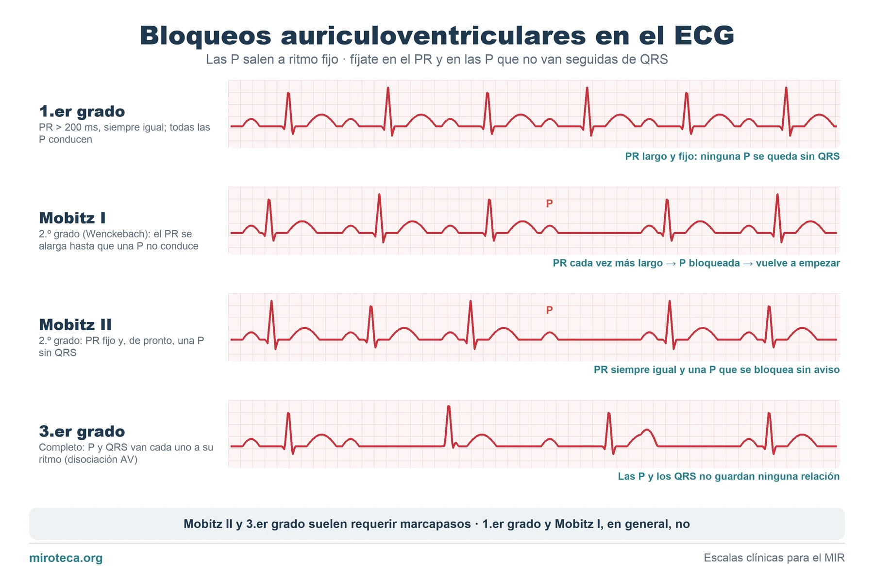 Cuatro tiras de electrocardiograma que muestran el bloqueo AV de primer grado, el Mobitz I o Wenckebach, el Mobitz II y el bloqueo AV completo