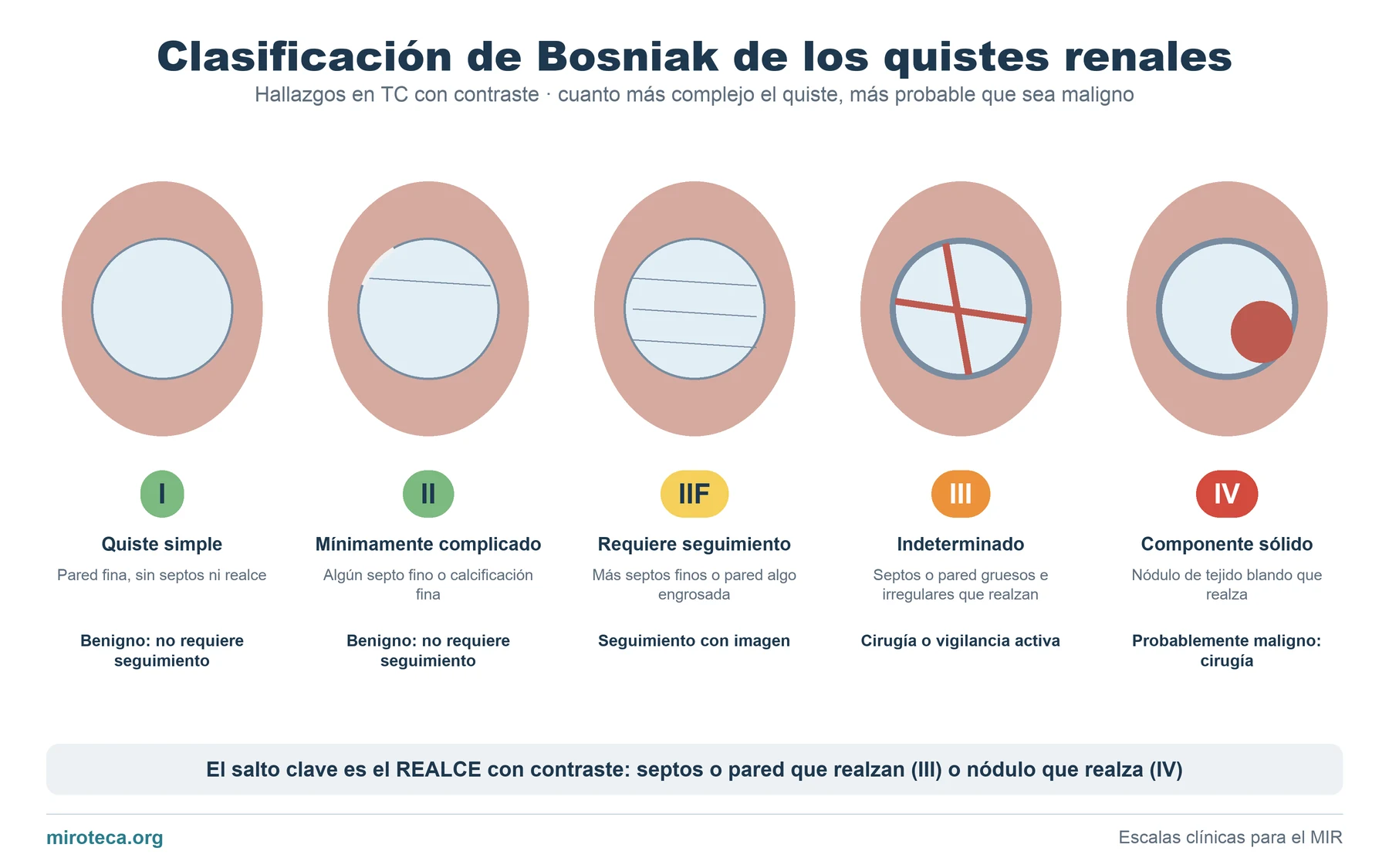 Cinco riñones con un quiste cada vez más complejo que ilustran las categorías I, II, IIF, III y IV de Bosniak: septos, pared gruesa y nódulo sólido