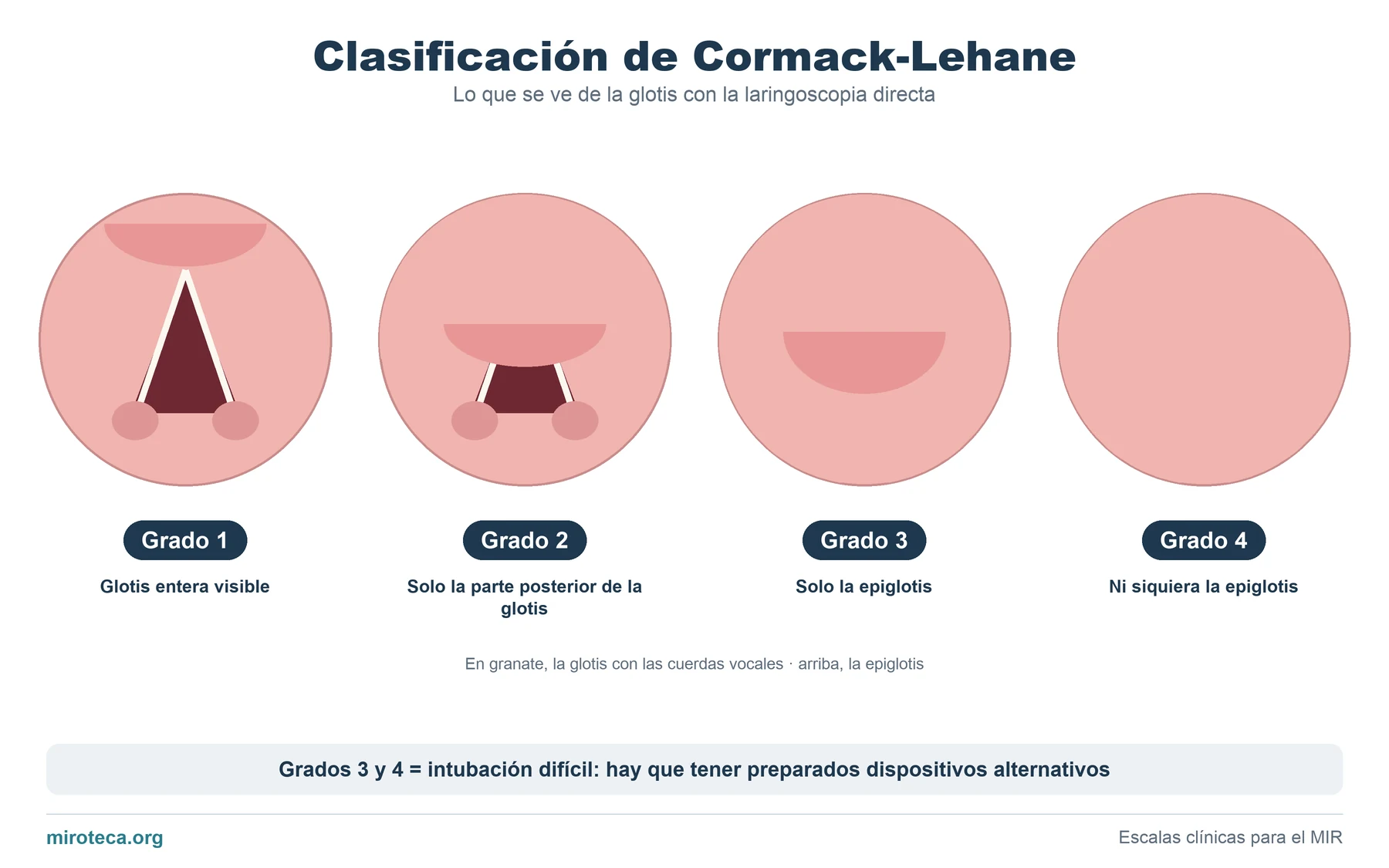 Cuatro vistas laringoscópicas que muestran los grados 1, 2, 3 y 4 de Cormack-Lehane, desde la glotis entera visible hasta no ver ni la epiglotis