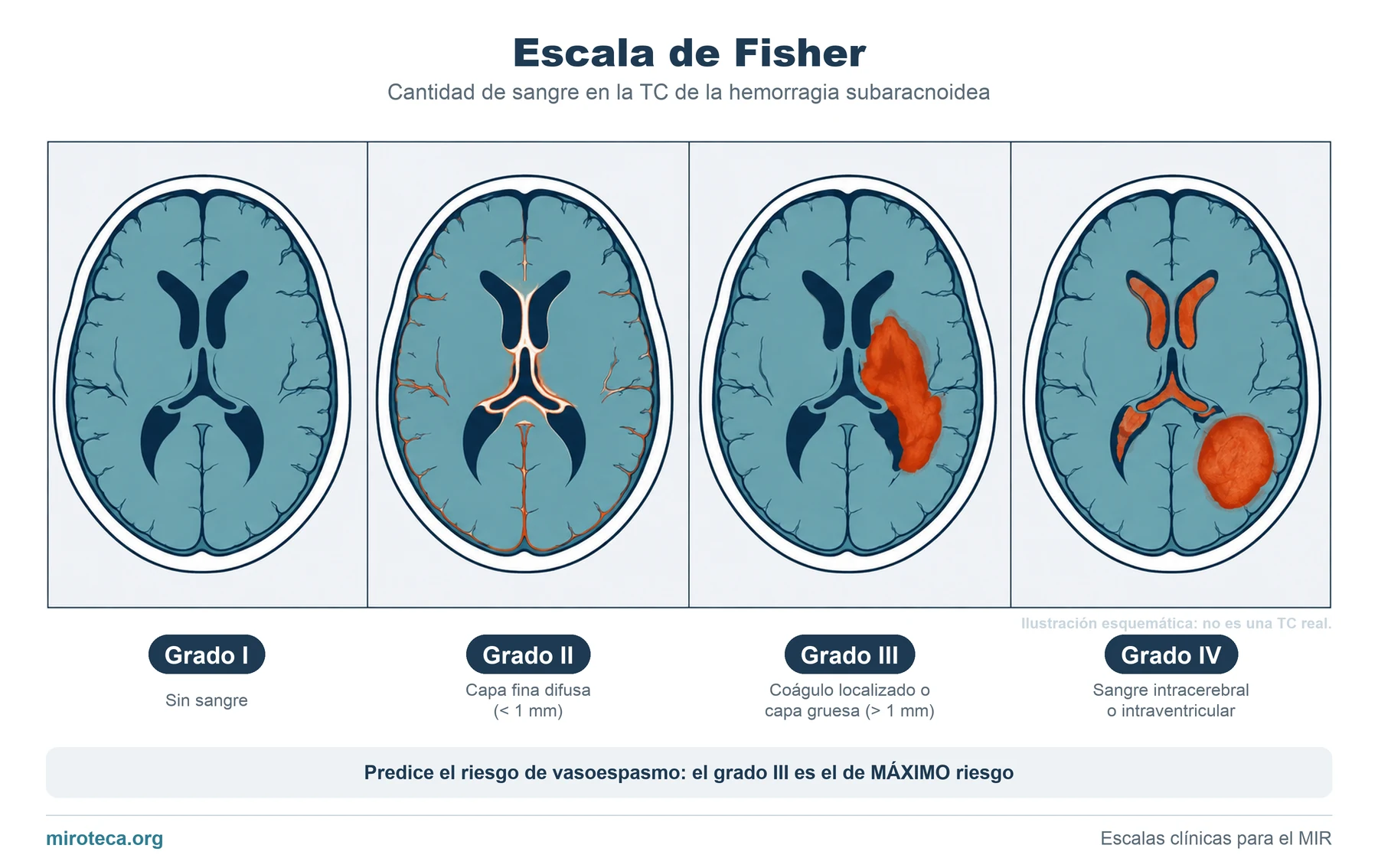 Escala de Fisher: los 4 grados de sangre en la hemorragia subaracnoidea, ilustrados sobre un esquema del cerebro visto desde arriba
