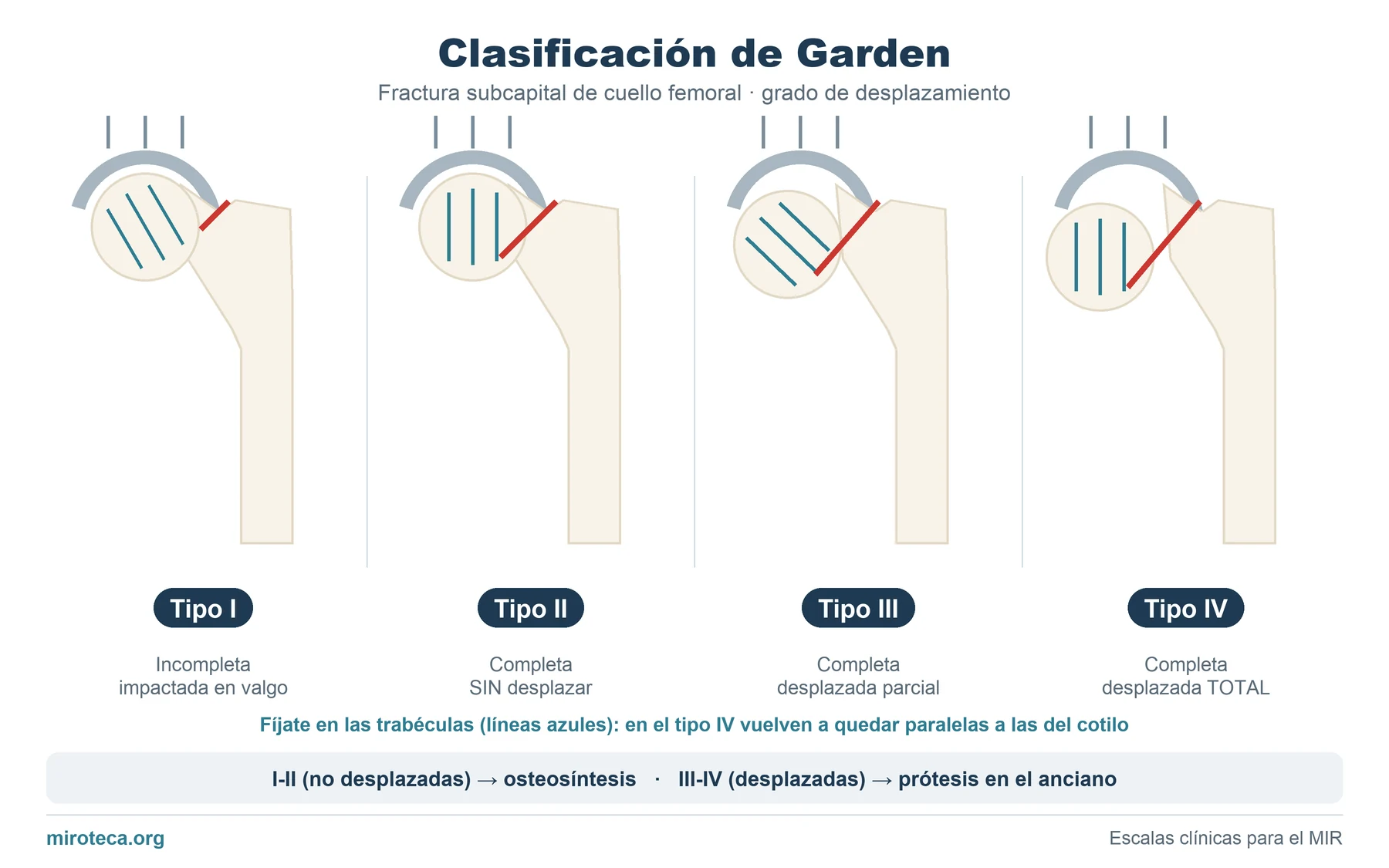 Clasificación de Garden: los 4 tipos de fractura subcapital de cuello femoral según el grado de desplazamiento y la orientación de las trabéculas