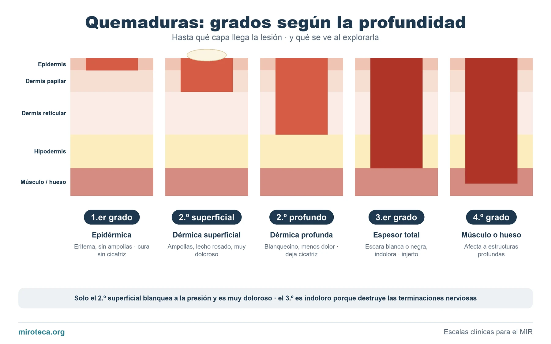 Cortes de piel con la lesión en rojo llegando cada vez más hondo: quemaduras de primer grado, segundo grado superficial, segundo grado profundo, tercer y cuarto grado