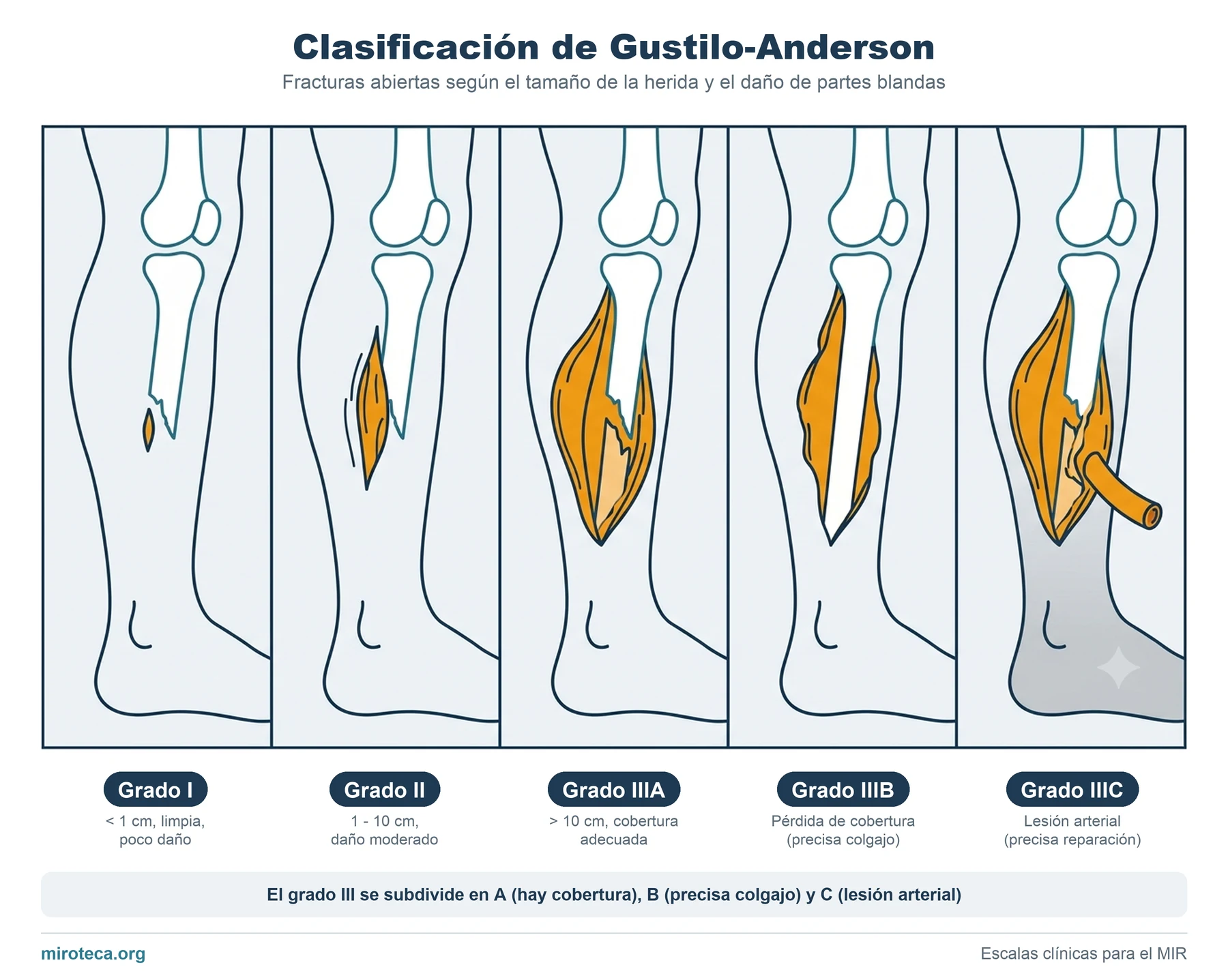 Clasificación de Gustilo-Anderson: los grados I, II, IIIA, IIIB y IIIC de fractura abierta según el tamaño de la herida y el daño de partes blandas