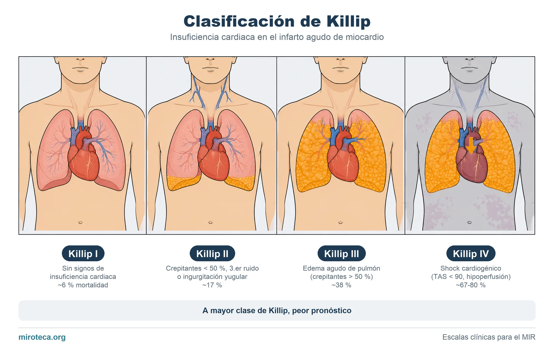 Clasificación de Killip: las 4 clases de insuficiencia cardiaca en el infarto agudo de miocardio, con su mortalidad, desde pulmones limpios hasta el shock cardiogénico