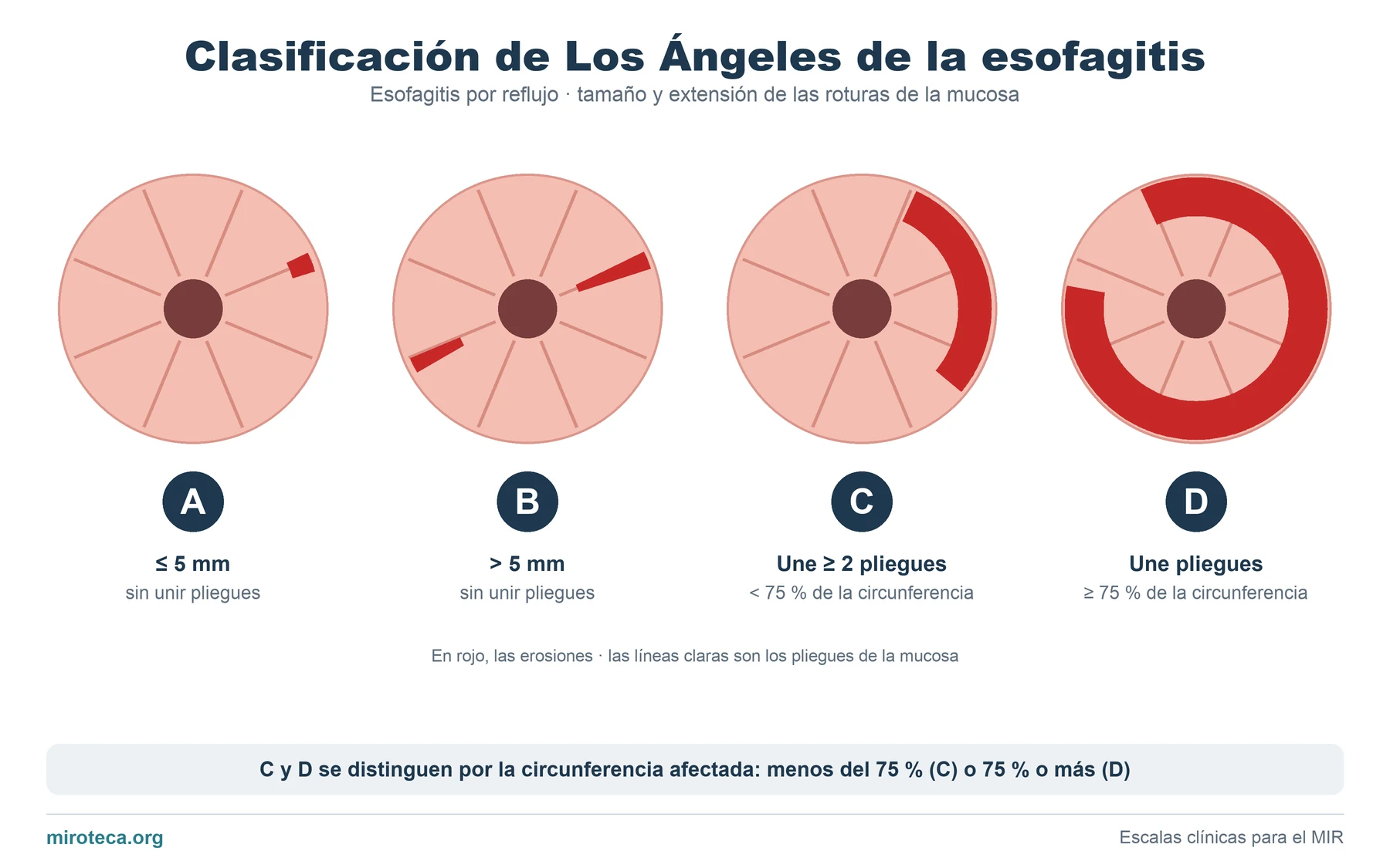Cuatro cortes del esófago visto por endoscopia con erosiones en rojo que ilustran los grados A, B, C y D de la clasificación de Los Ángeles