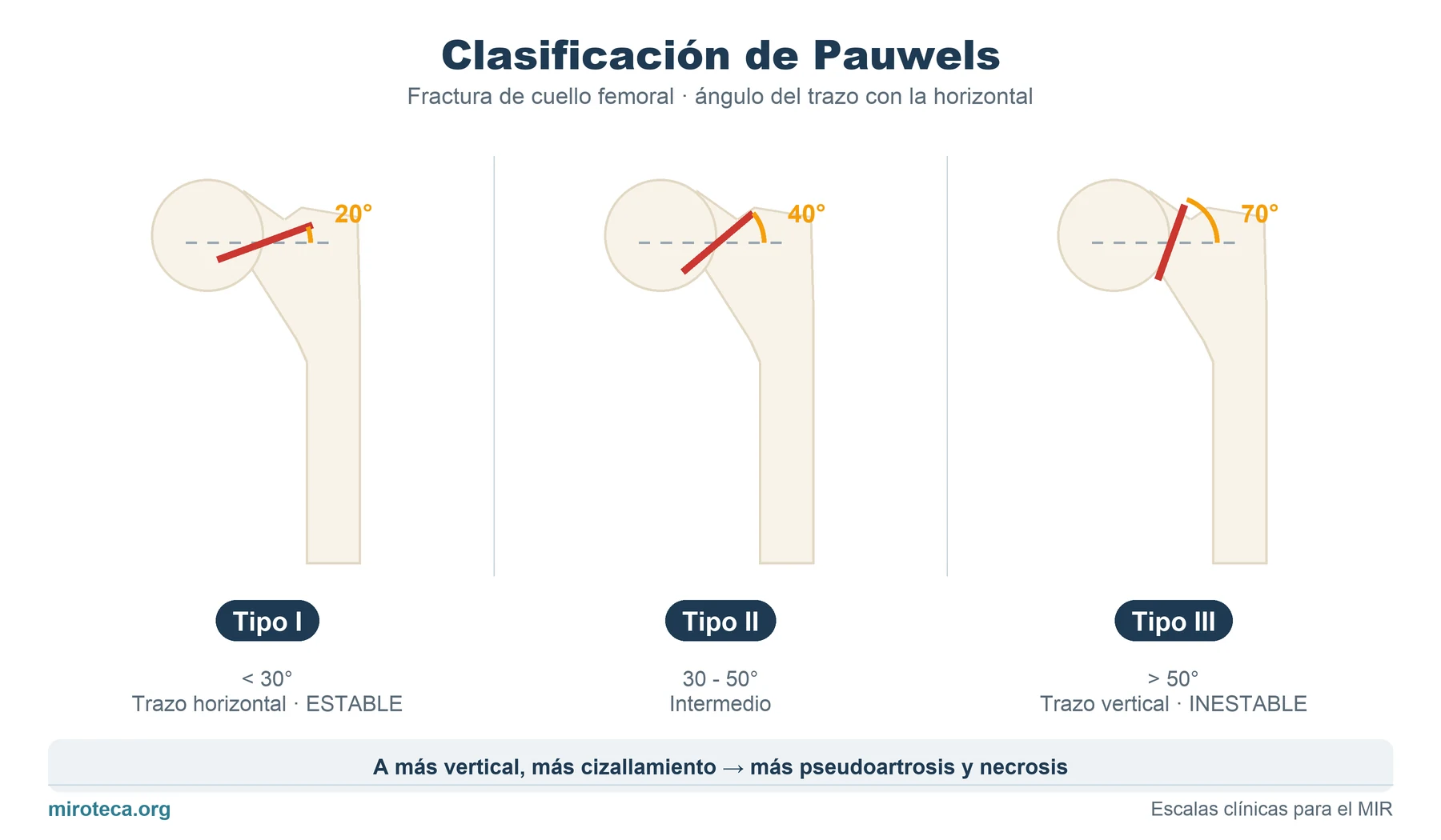 Clasificación de Pauwels: los 3 tipos de fractura de cuello femoral según el ángulo del trazo con la horizontal, menos de 30 grados, 30 a 50 y más de 50