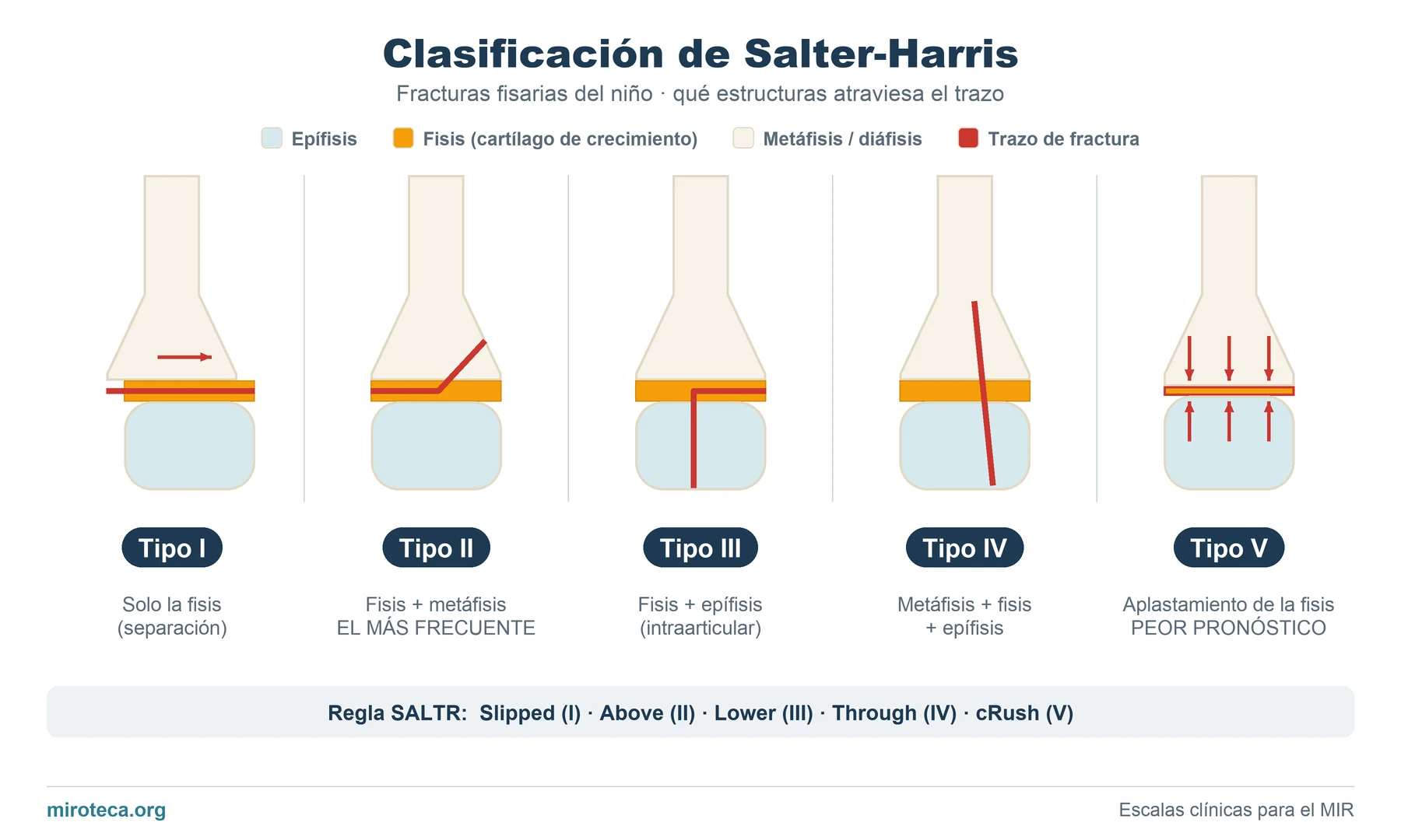 Clasificación de Salter-Harris: esquema de los 5 tipos de fractura fisaria, con el trazo señalado sobre la fisis, la metáfisis y la epífisis
