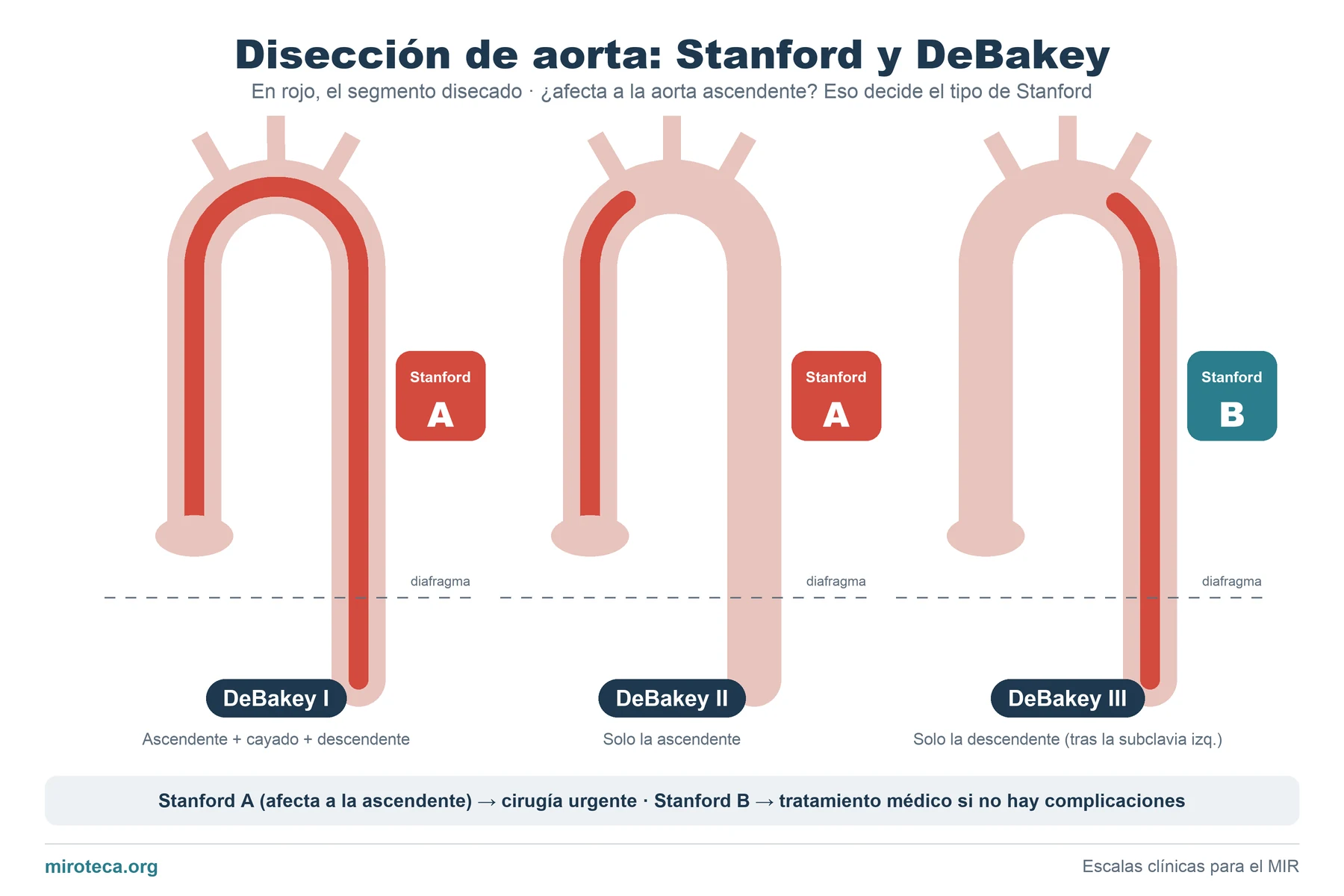 Tres dibujos de la aorta con el segmento disecado en rojo que muestran los tipos I, II y III de DeBakey y su equivalencia con Stanford A y B