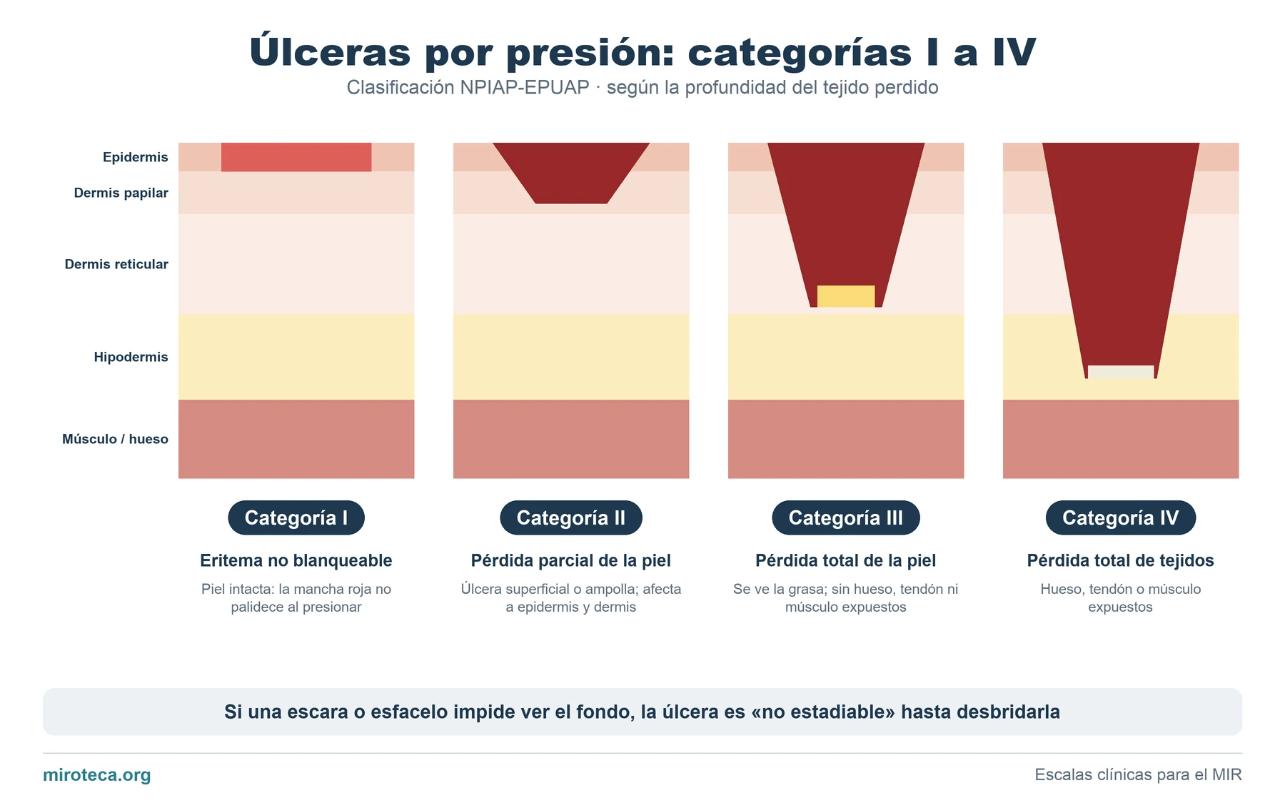 Cortes de piel con úlceras cada vez más profundas que ilustran las categorías I, II, III y IV de las úlceras por presión