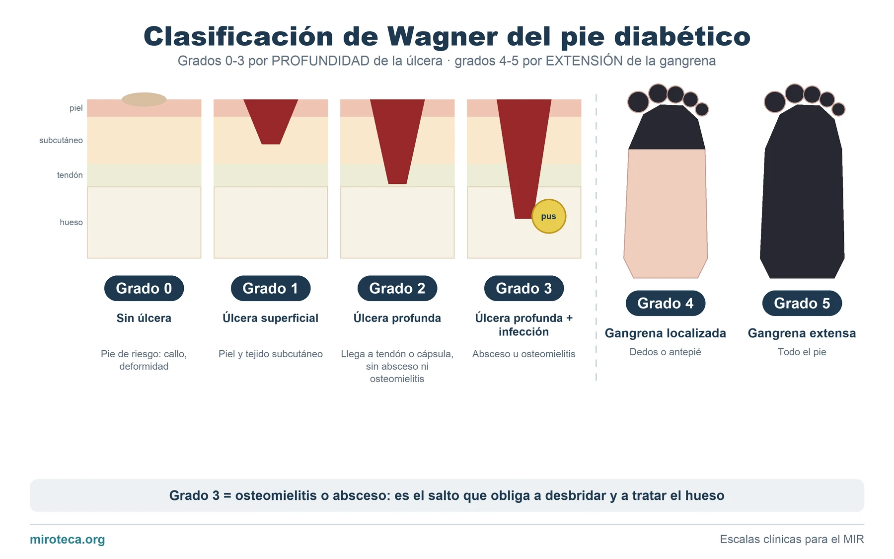 Esquema de la clasificación de Wagner: cortes de piel con úlceras cada vez más profundas para los grados 0 a 3 y dos pies con gangrena localizada y extensa para los grados 4 y 5