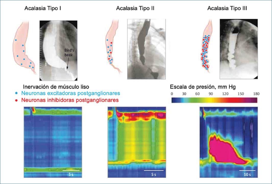 Tipos de acalasia (clasificación de Chicago)
